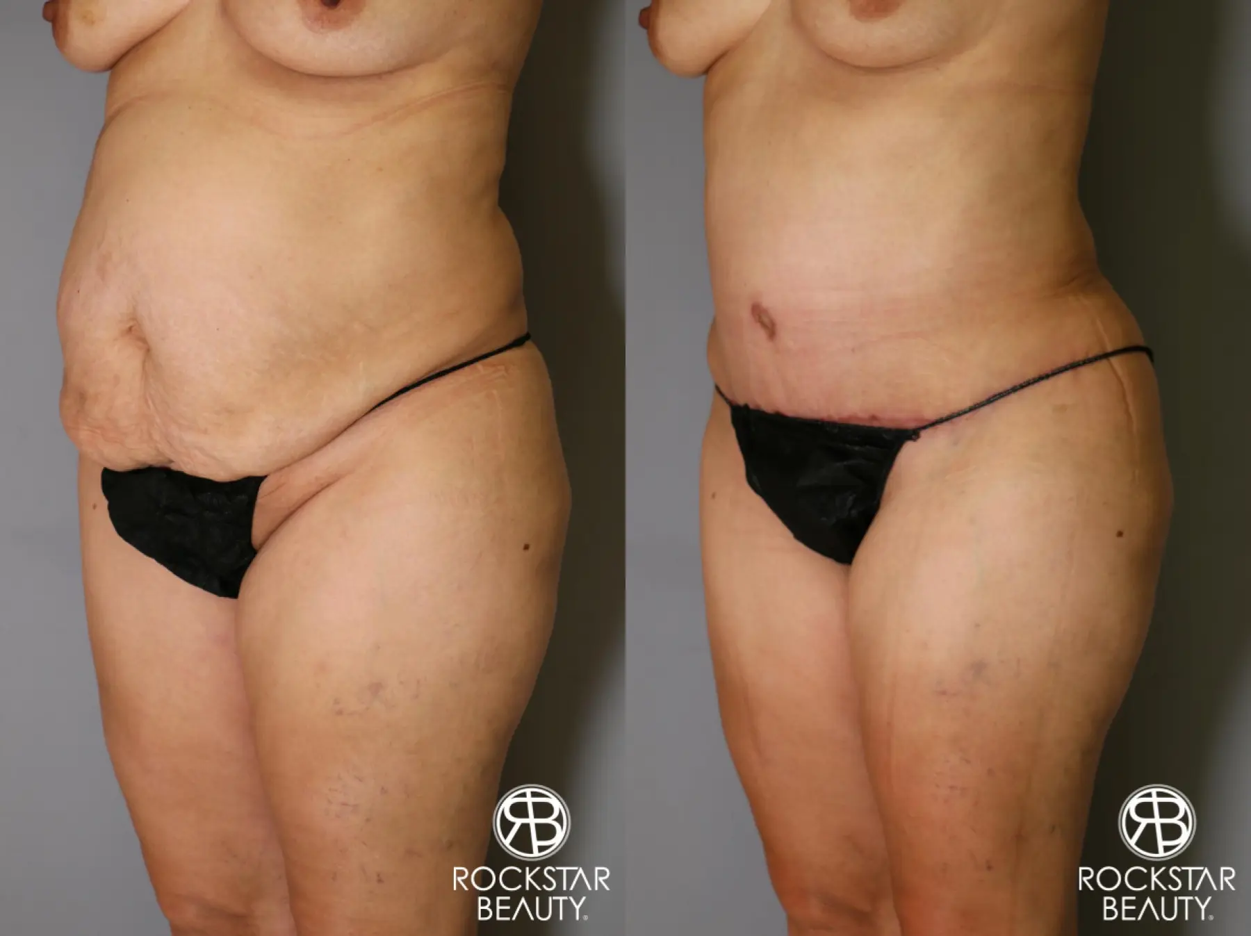 Tummy Tuck: Patient 13 - Before and After 3