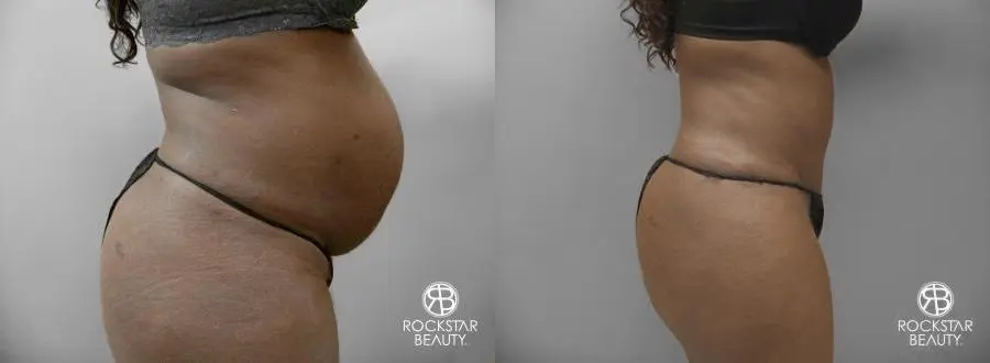Tummy Tuck: Patient 7 - Before and After 2
