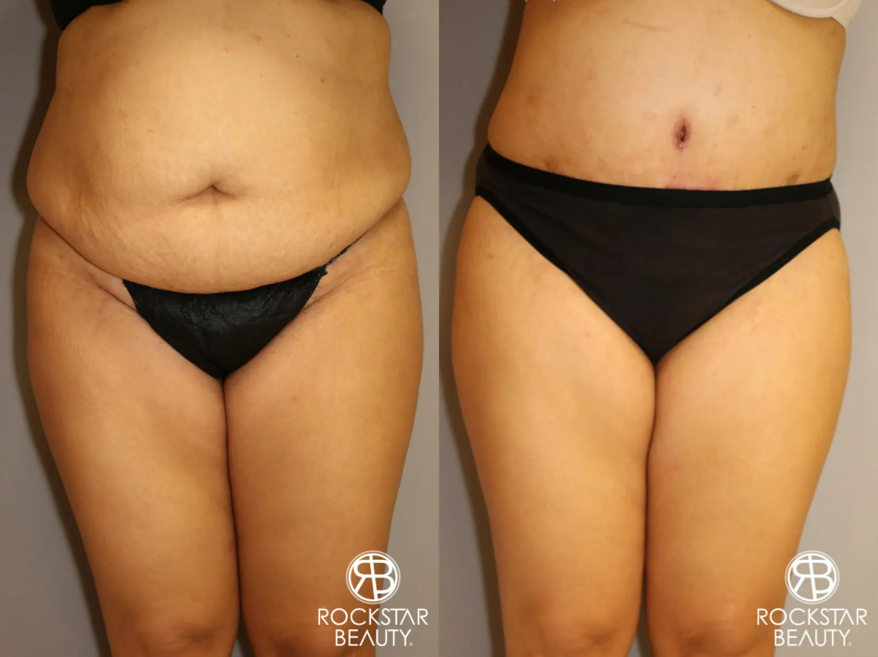 Tummy Tuck: Patient 2 - Before and After 1