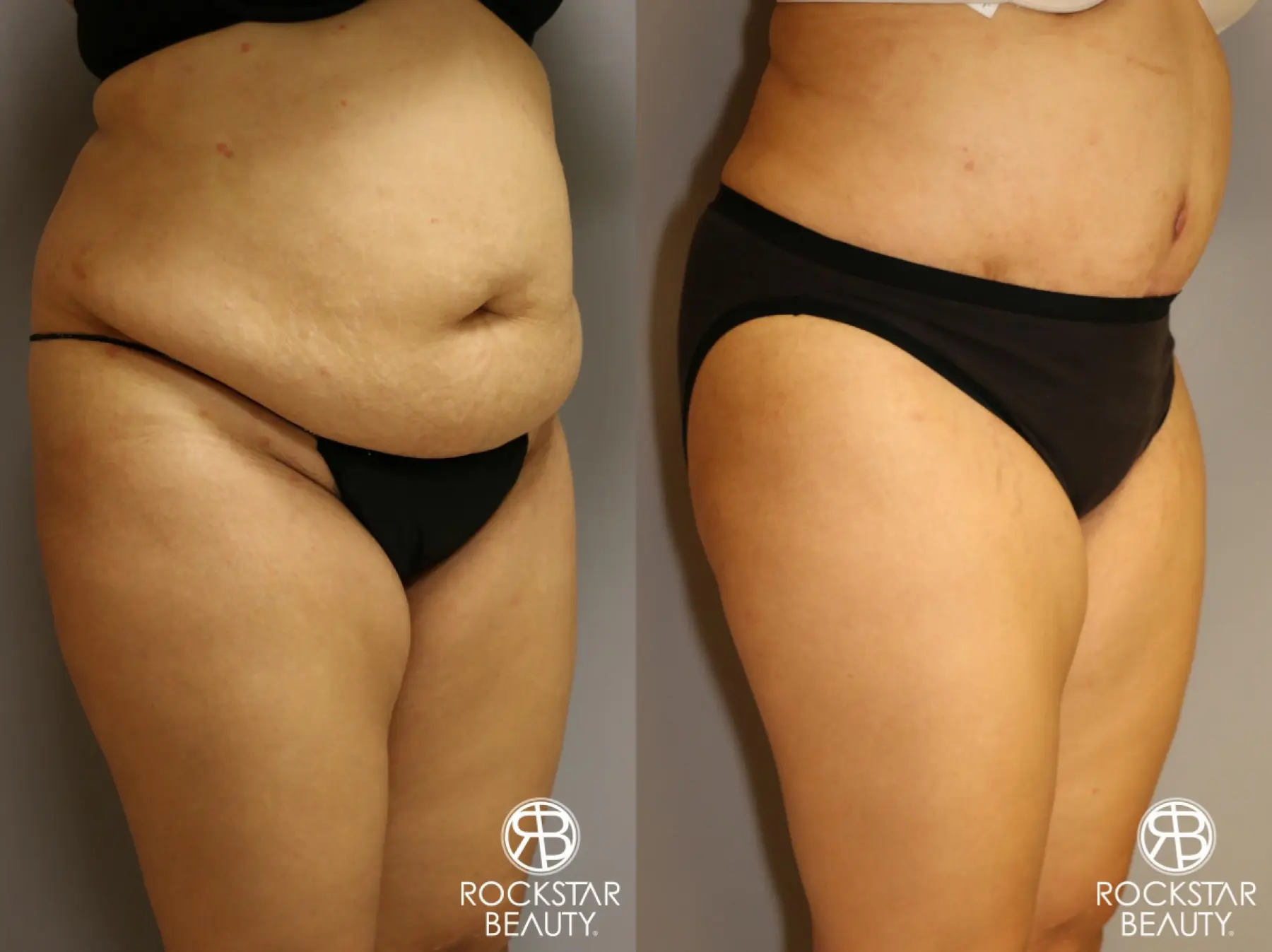 Tummy Tuck: Patient 2 - Before and After 2