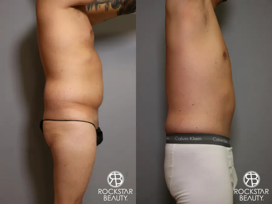 Tummy Tuck: Patient 5 - Before and After 4