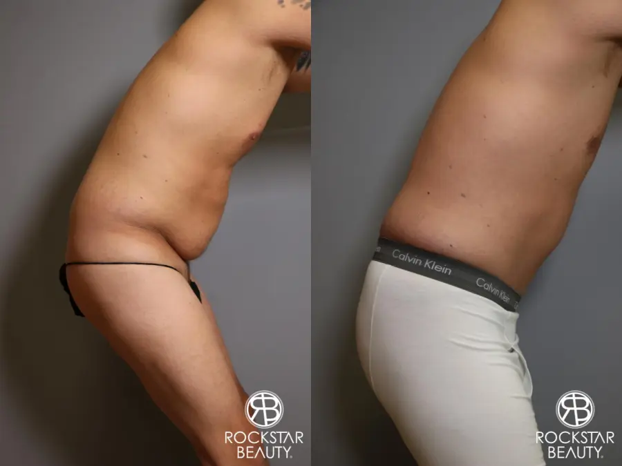Tummy Tuck: Patient 5 - Before and After 1