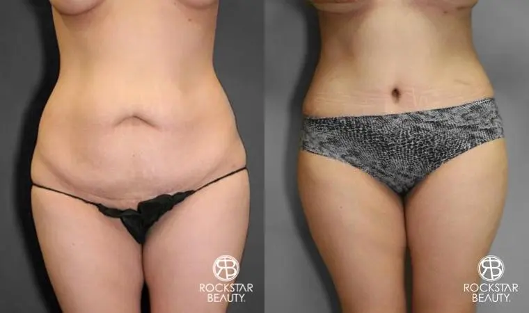 Tummy Tuck: Patient 10 - Before and After  