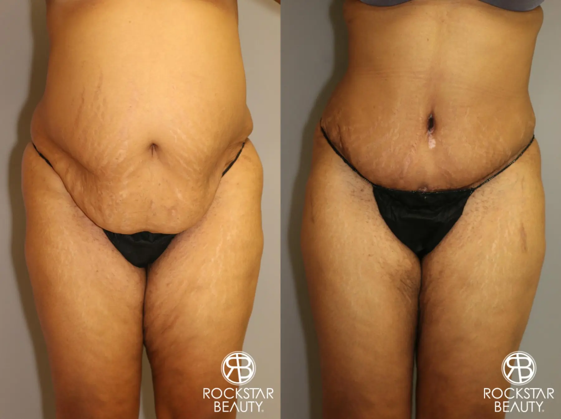 Tummy Tuck: Patient 3 - Before and After 1