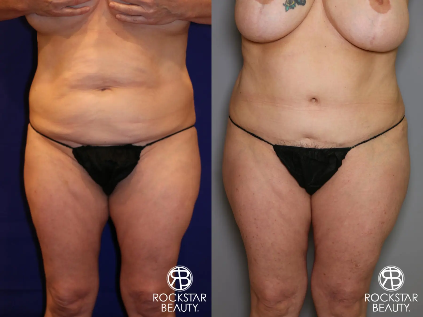 Tummy Tuck: Patient 12 - Before and After 1