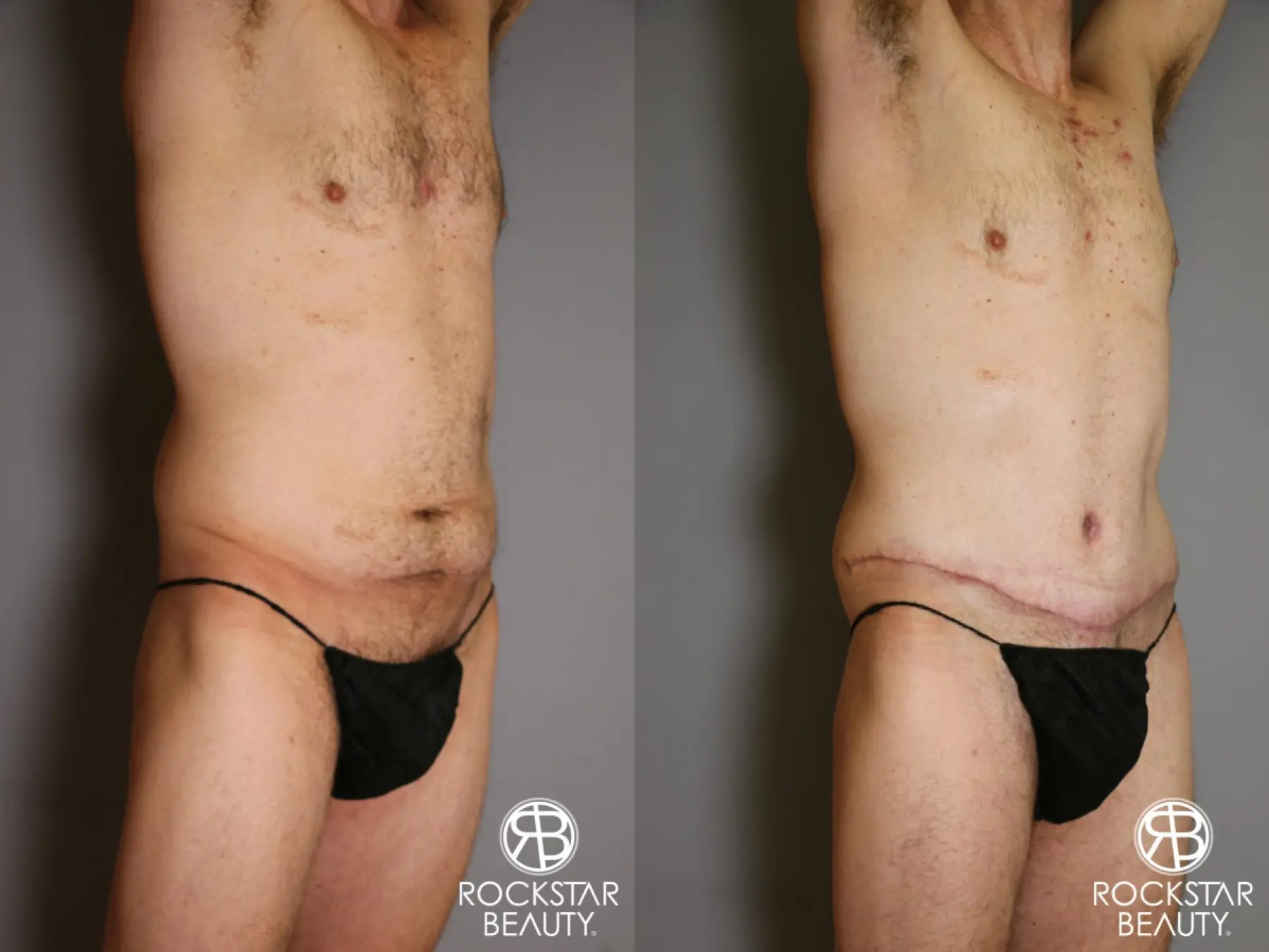 Tummy Tuck: Patient 11 - Before and After 2