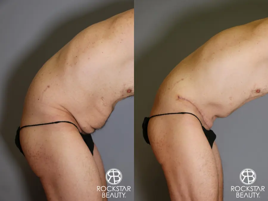 Tummy Tuck: Patient 11 - Before and After 3