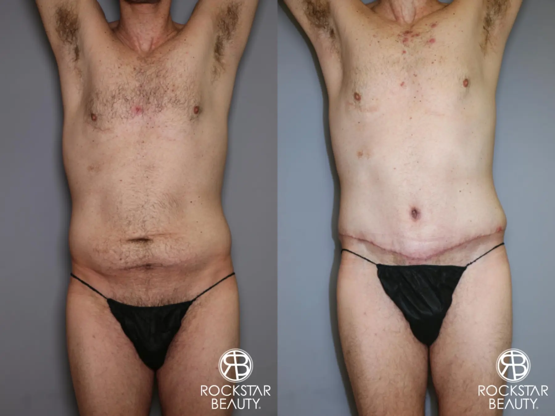 Tummy Tuck: Patient 11 - Before and After 1