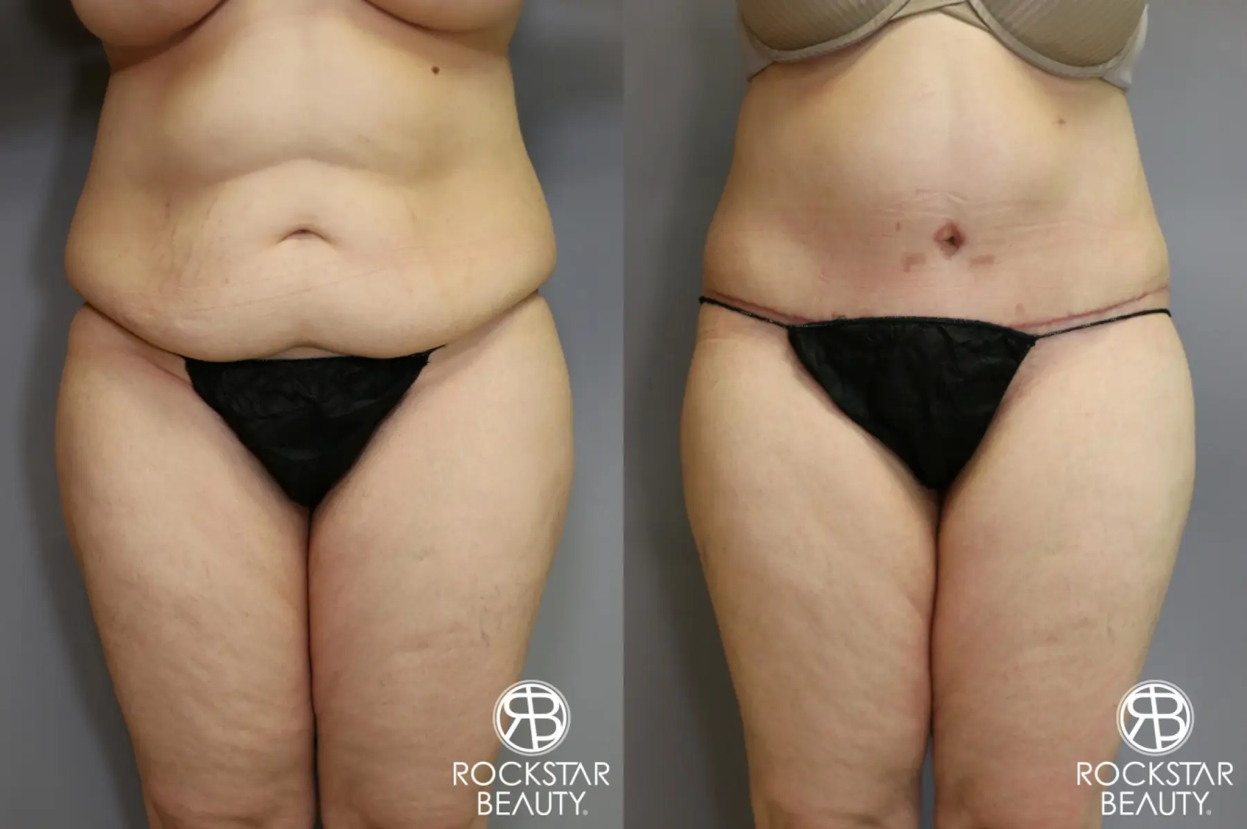 Tummy Tuck: Patient 4 - Before and After  