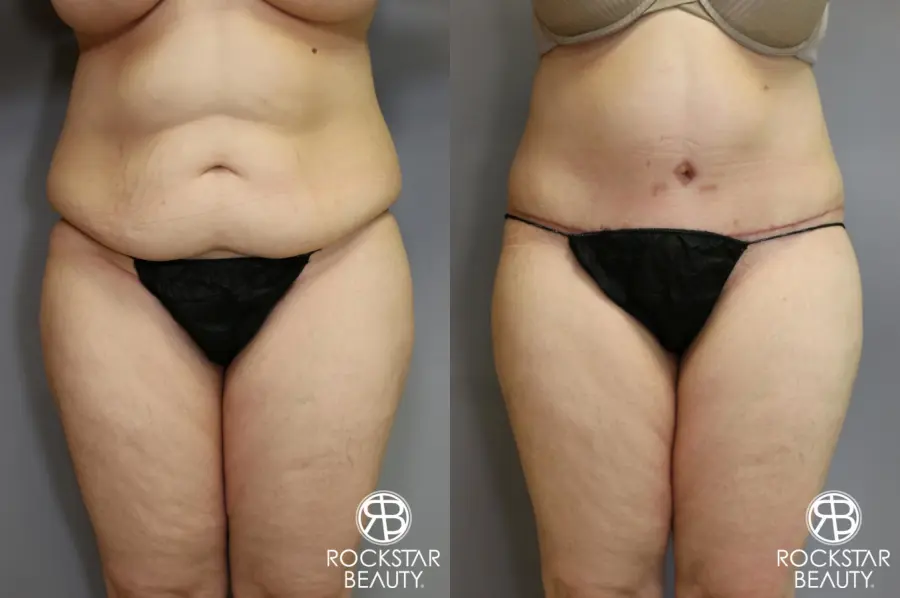 Tummy Tuck: Patient 4 - Before and After 1
