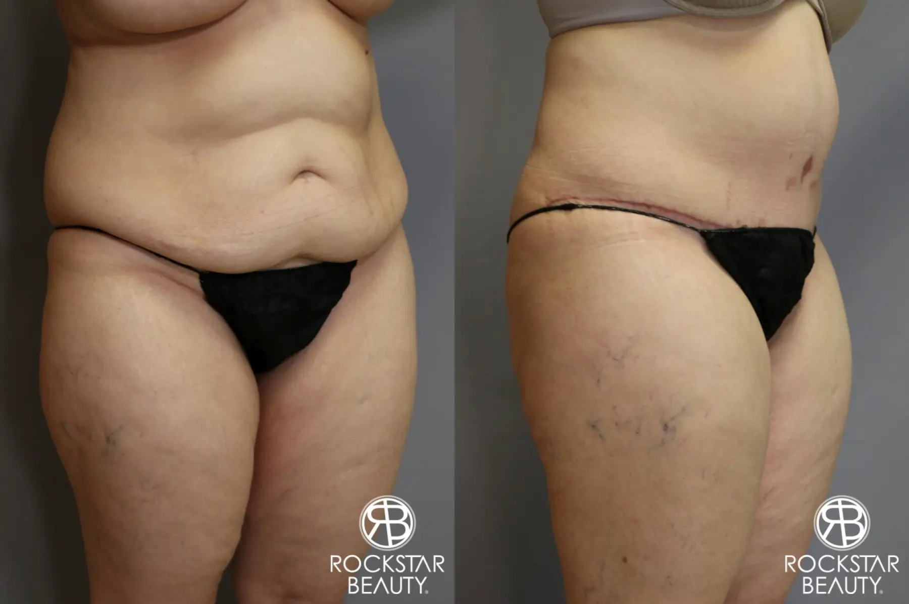 Tummy Tuck: Patient 4 - Before and After 2