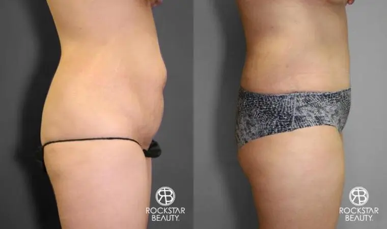 Tummy Tuck: Patient 10 - Before and After 3