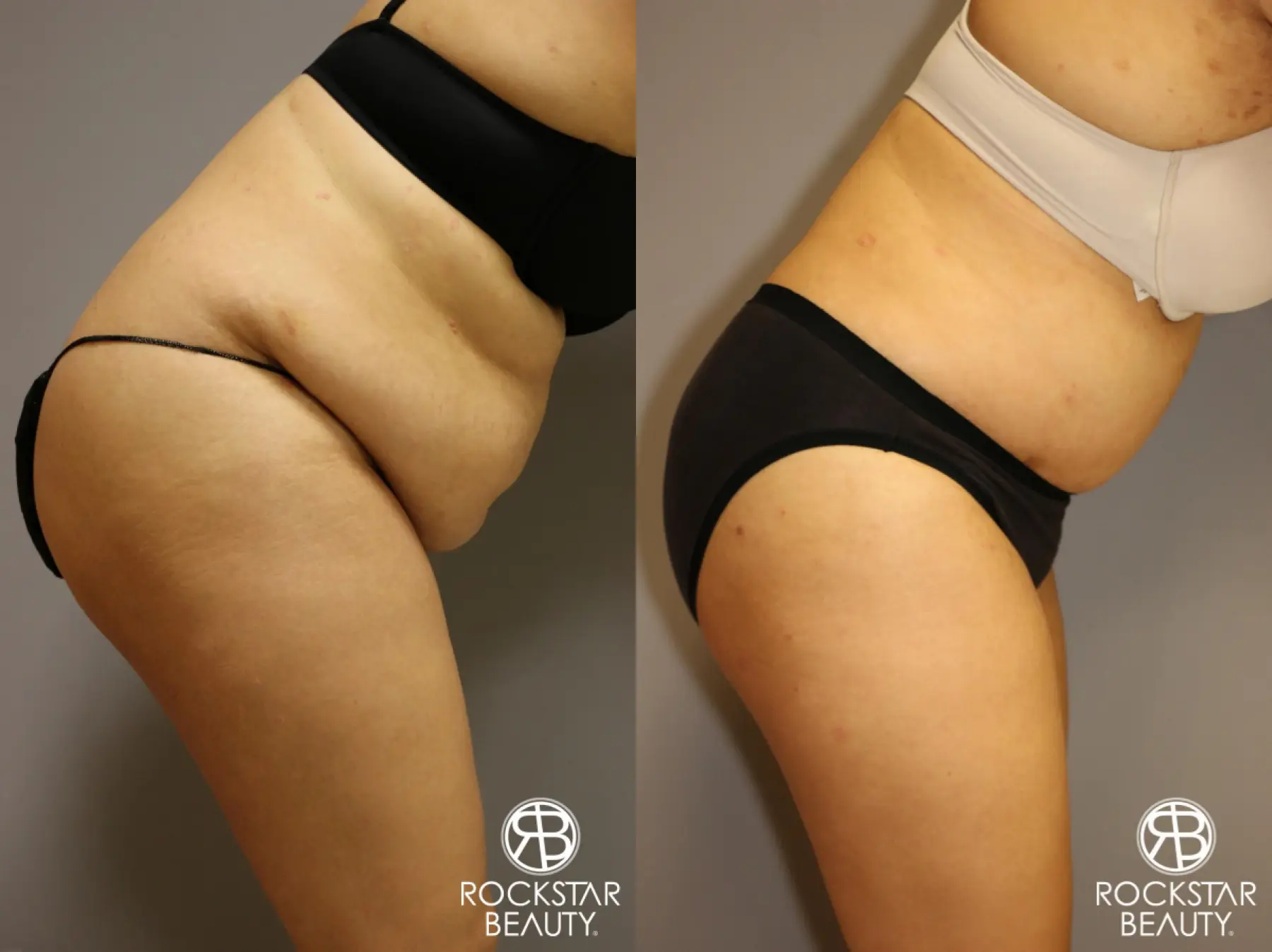 Tummy Tuck: Patient 2 - Before and After 4