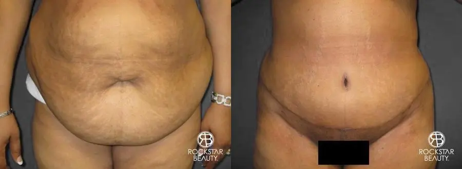 Tummy Tuck: Patient 8 - Before and After  