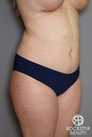 Liposuction: Patient 11 - After Image 2