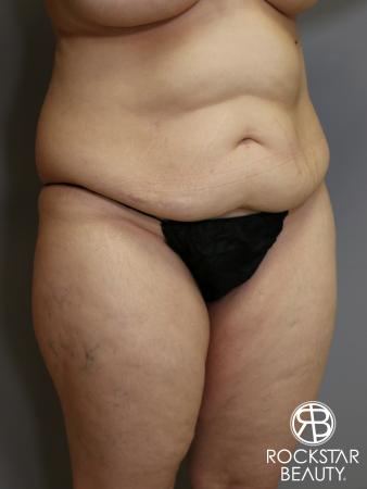 Tummy Tuck: Patient 4 - Before Image 2