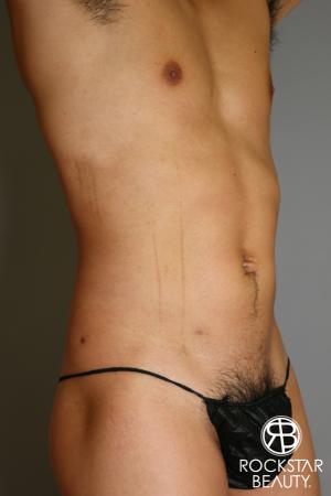 Liposuction: Patient 17 - After Image 3