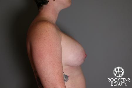Breast Augmentation: Patient 11 - After Image 3