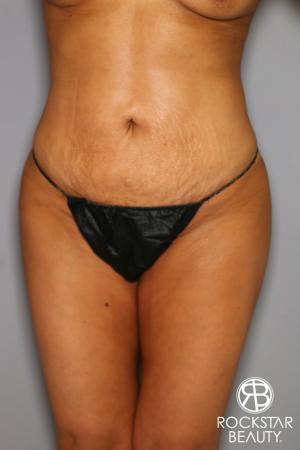Brazilian Butt Lift: Patient 12 - After Image 2