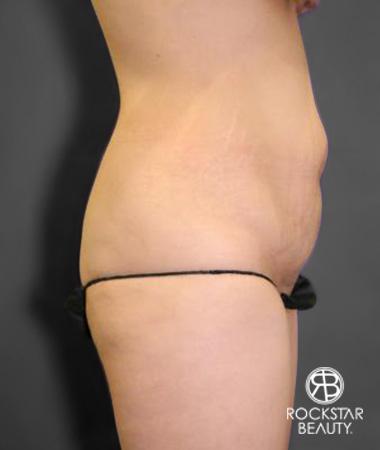 Tummy Tuck: Patient 10 - Before 3