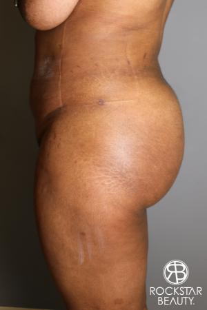 Brazilian Butt Lift: Patient 13 - After Image 3