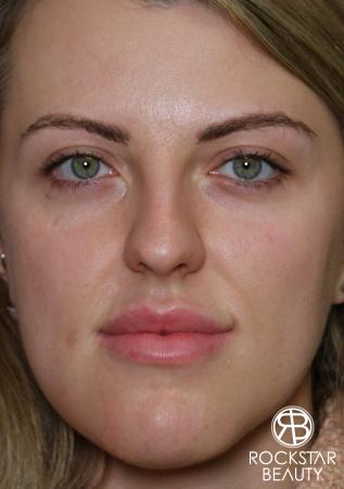 Rhinoplasty: Patient 1 - Before Image 3