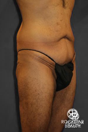 Body Lift: Patient 1 - Before Image 2
