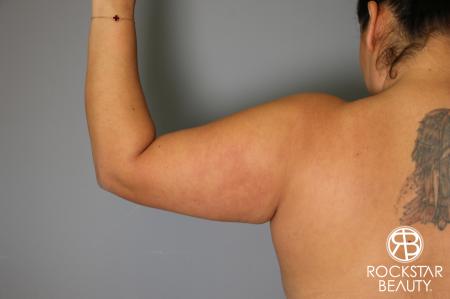 Liposuction: Patient 12 - Before Image 3