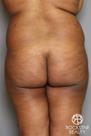 Brazilian Butt Lift: Patient 13 - Before Image 1
