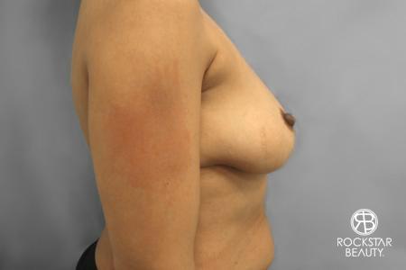 Combo Procedures - Breast: Patient 1 - Before 2