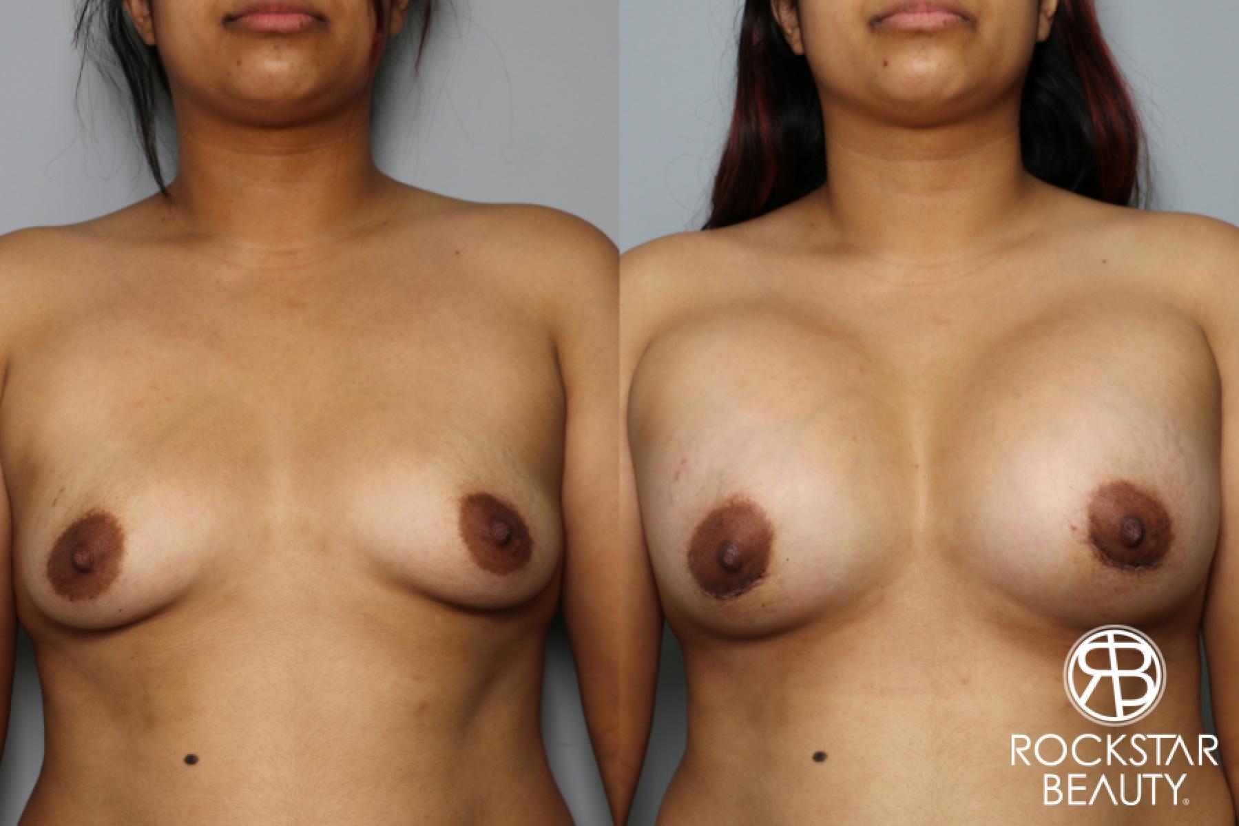 Breast Augmentation: Patient 10 - Before and After 1