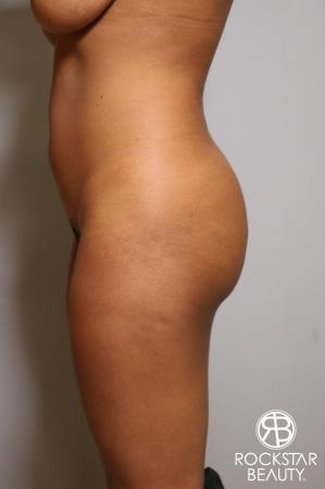 Liposuction: Patient 18 - Before Image 4