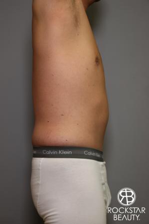 Tummy Tuck: Patient 5 - After Image 4