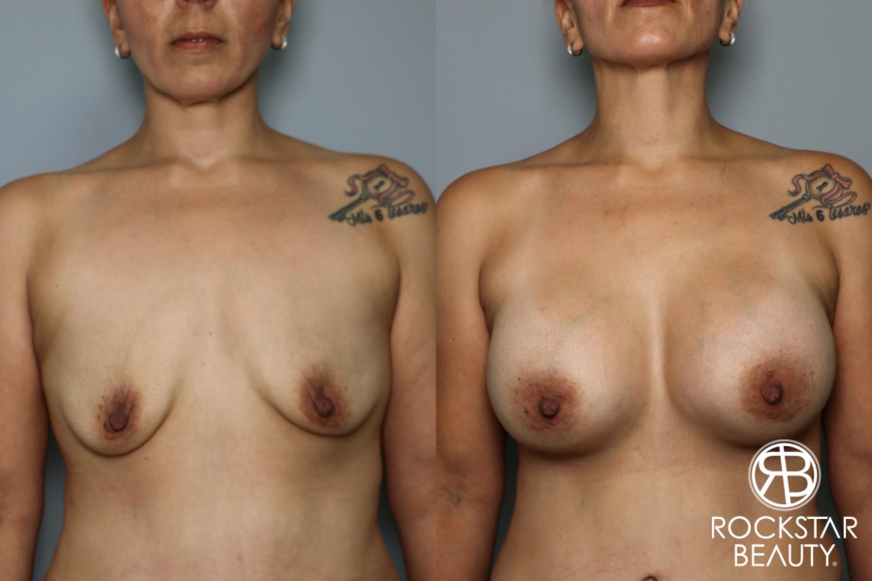 Breast Augmentation: Patient 41 - Before and After 1