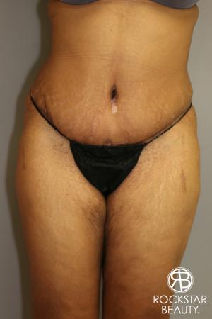 Tummy Tuck: Patient 3 - After Image 1