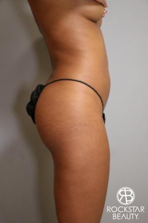Liposuction: Patient 1 - Before Image 3