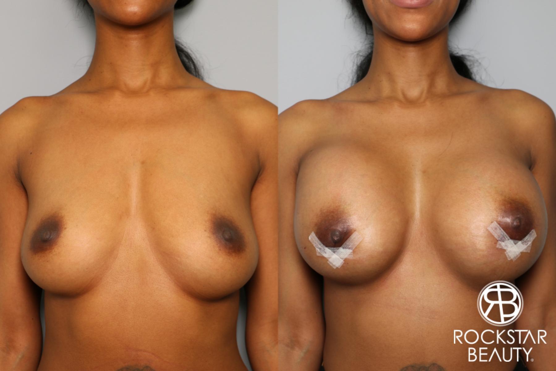 Breast Augmentation: Patient 35 - Before and After 1