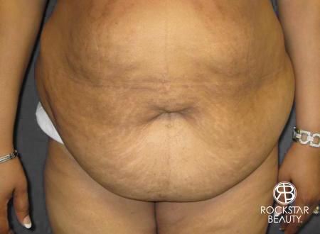Tummy Tuck: Patient 8 - Before 1