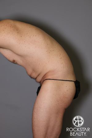 Tummy Tuck: Patient 11 - Before and After Image 5