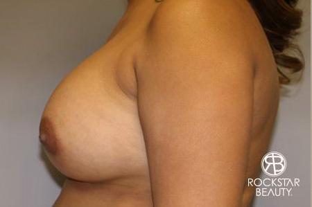 Breast Augmentation: Patient 9 - After 4