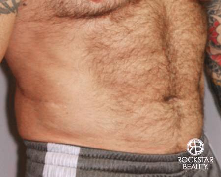 SmartLipo®: Patient 2 - After Image 2