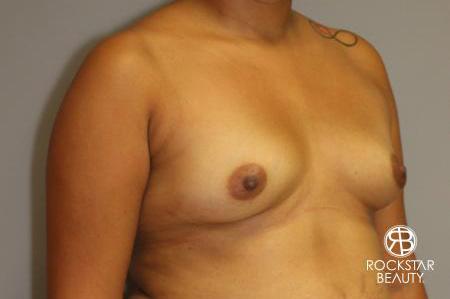 Breast Augmentation: Patient 9 - Before 2