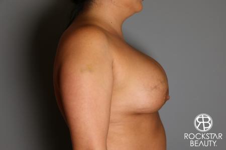 Breast Implant Exchange: Patient 1 - Before and After Image 5