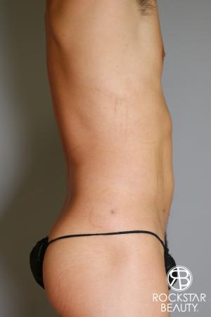 Liposuction: Patient 17 - After Image 1