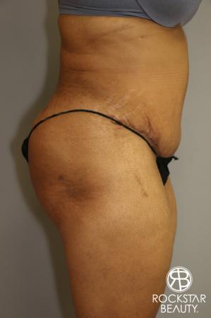 Tummy Tuck: Patient 3 - After Image 3