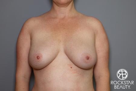 Combo Procedures - Breast: Patient 2 - After Image 1