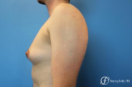 Denver FTM Female to Male Top Surgery 7708 - Before and After Image 3