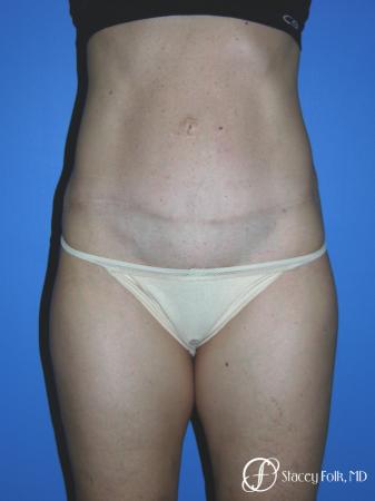 Denver Tummy Tuck Abdominoplasty 5485 - After Image 1