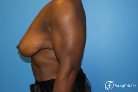 Denver Breast Reduction (Mastopexy) 7081 - Before and After Image 3
