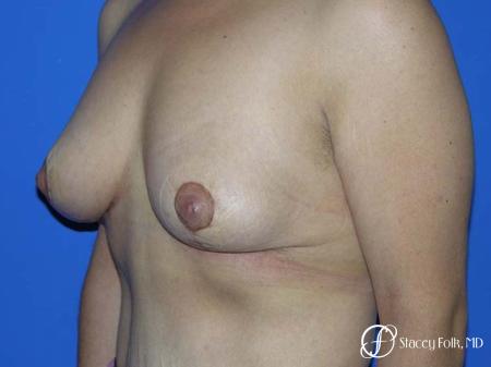 Denver Breast Lift - Mastopexy 7982 - After Image 2